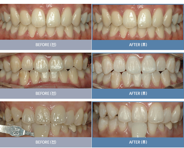 ����Ʈ ġ�ƹ̹�