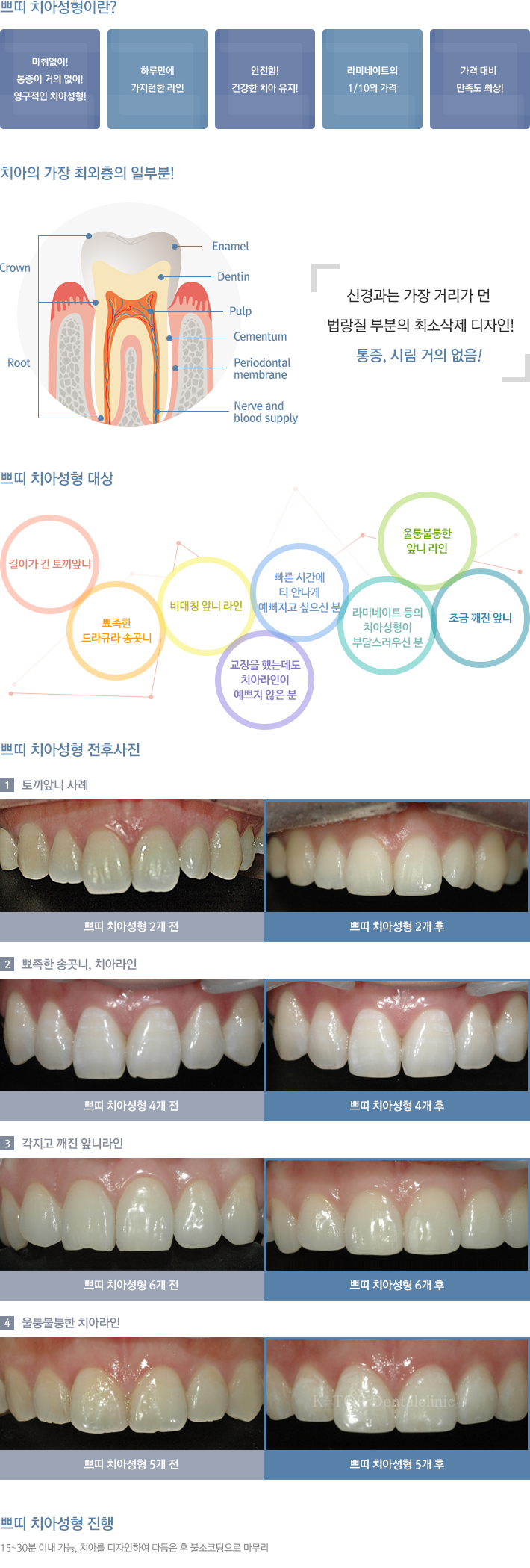 �ڶ� ġ�Ƽ���